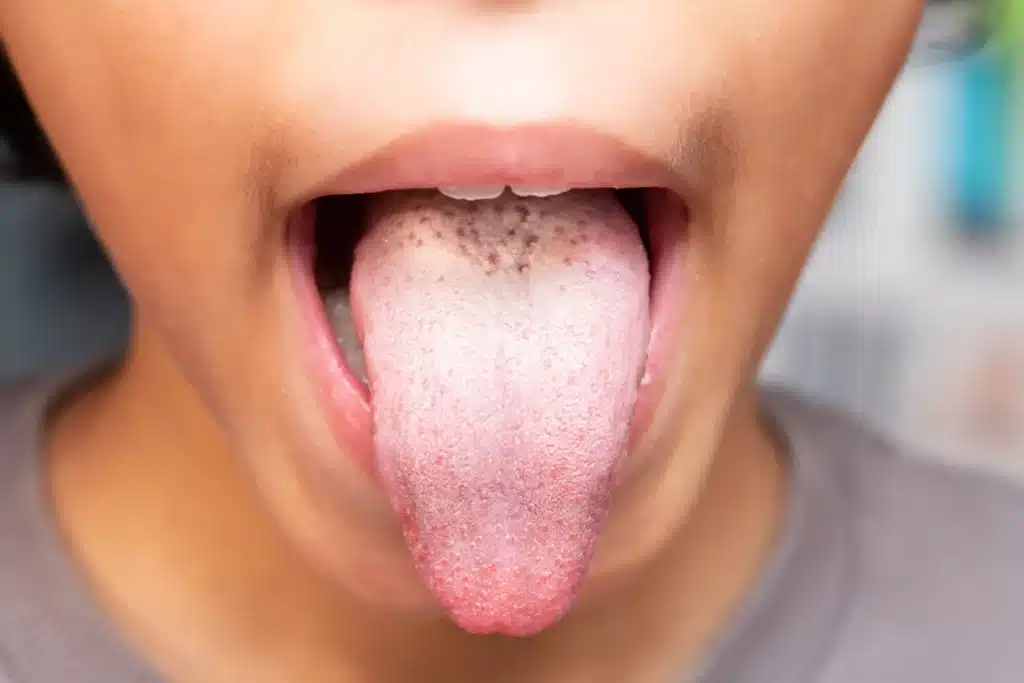 Anzeichen von Mundsoor bei einem kleinen Jungen