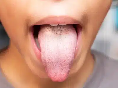 Anzeichen von Mundsoor bei einem kleinen Jungen