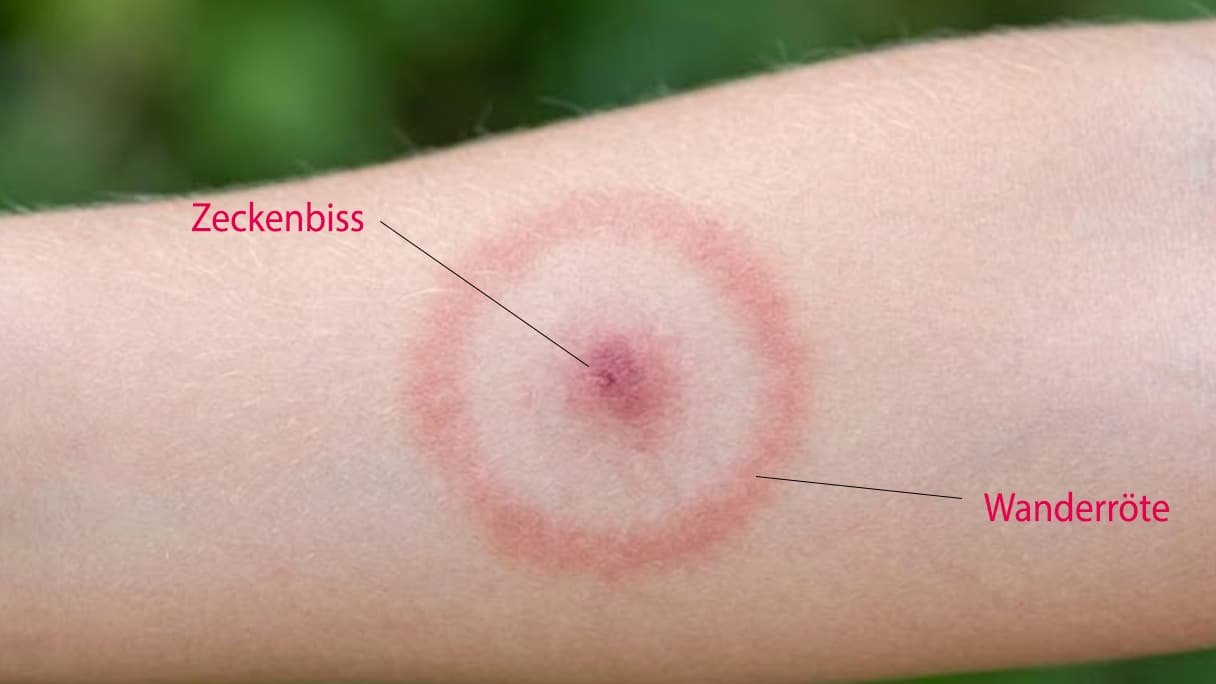 Borreliose Kinder Anzeichen ring f´von borreliose