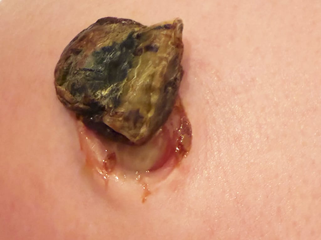 Nabelschnur Faellt Ab Baby