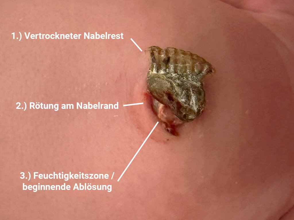 Nabelschnur Loest Sich Baby Infografik
