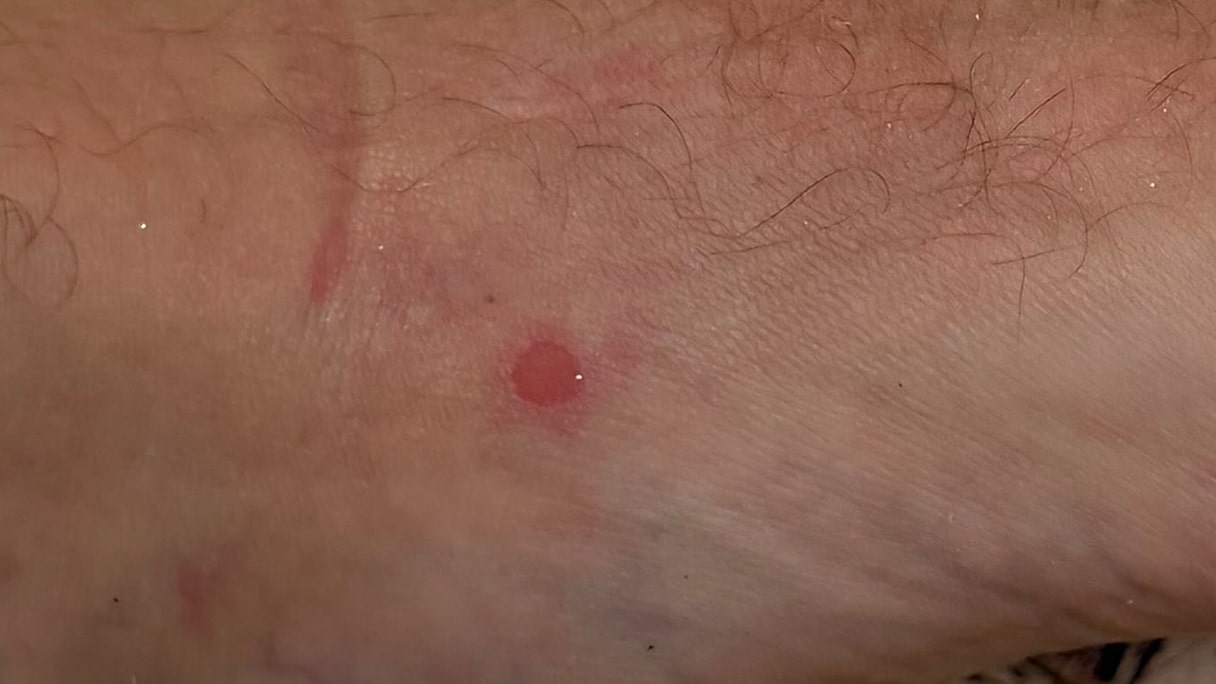 Offene Blase richtig behandelt am Fuss